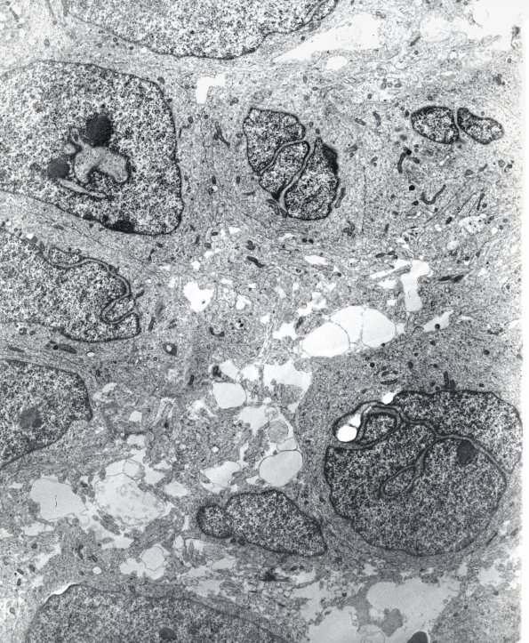 13C1 Medulloblastoma (Case 13C) EM 1 (2) - Copy