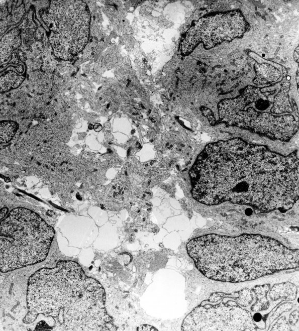 13C2 Medulloblastoma (Case 13C) EM 1 - Copy