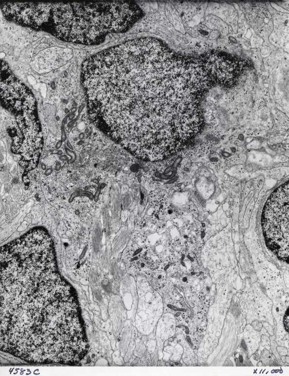 13D Medulloblastoma (Case 13D) EM 1 - Copy