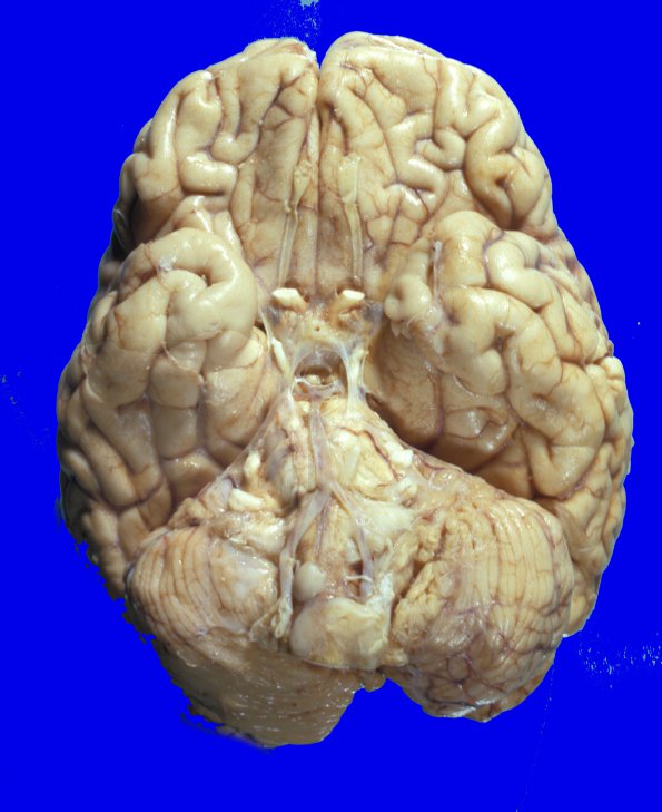 14A Medulloblastoma (Case 14) - Copy