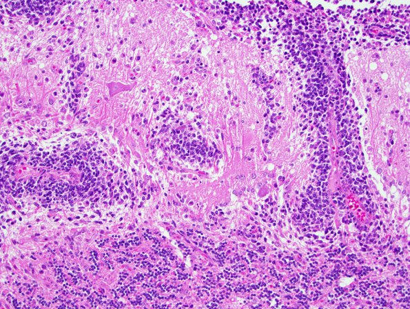 15A4 Medulloblastoma, Re-Entry (Case 15) 2.jpg
