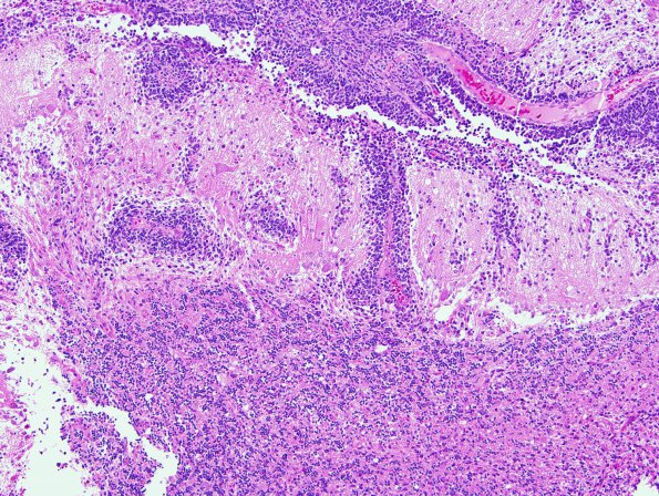 15A5 (Case 15) Medulloblastoma, Re-Entry (Case 15) 1.jpg