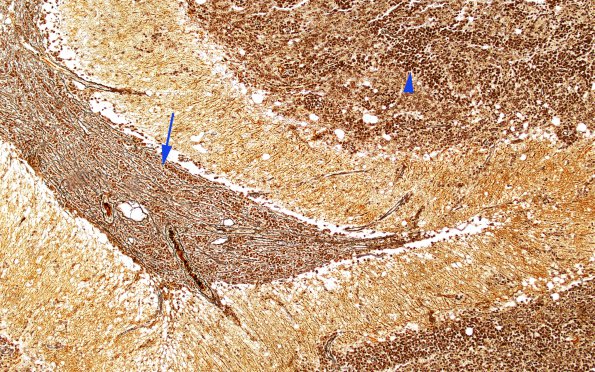 15B1 (Case 15) Medulloblastoma, Re-Entry  Retic 10X copy