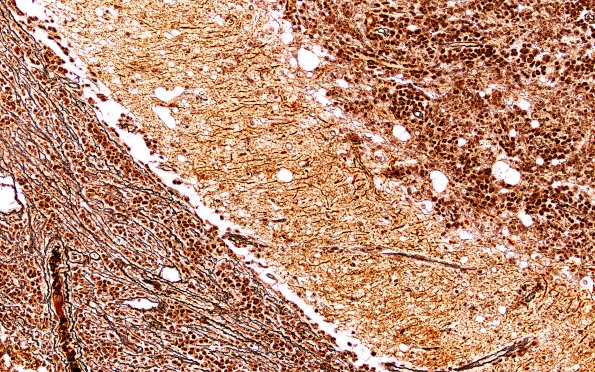 15B2 (Case 15) Medulloblastoma, Re-Entry  Retic 20X