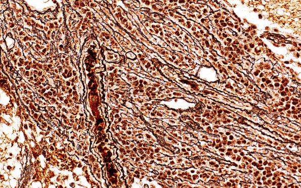 15B3 (Case 15) Medulloblastoma, Re-Entry  Retic 40X in SAS