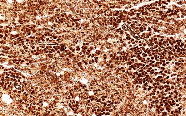 15B4 (Case 15) Medulloblastoma, Re-Entry  Retic 40X in parenchyma