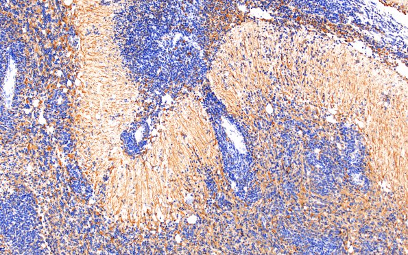 15C1 (Case 15) Medulloblastoma, Re-Entry  GFAP 10X