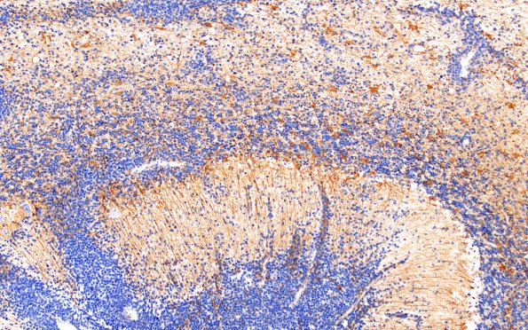 15C2 (Case15) Medulloblastoma, Re-Entry  GFAP 10X 2