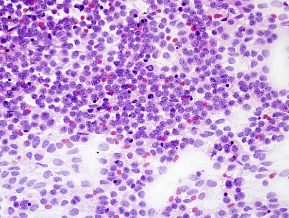 16A1 Medulloblastoma (Case 16) smear H&E 2.jpg