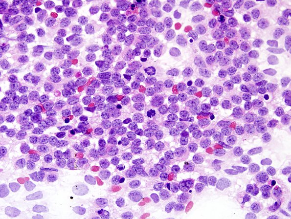 16A2 Medulloblastoma (Case 16) smear H&E 1.jpg