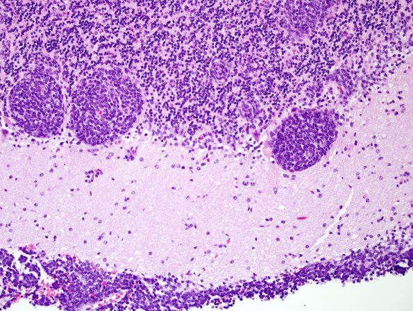 16A3 Medulloblastoma (Case 16) H&E 1.jpg