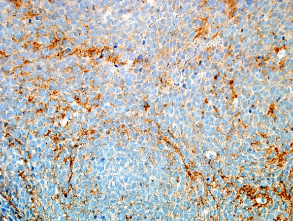 16B Medulloblastoma (Case 16) SYN 1.jpg