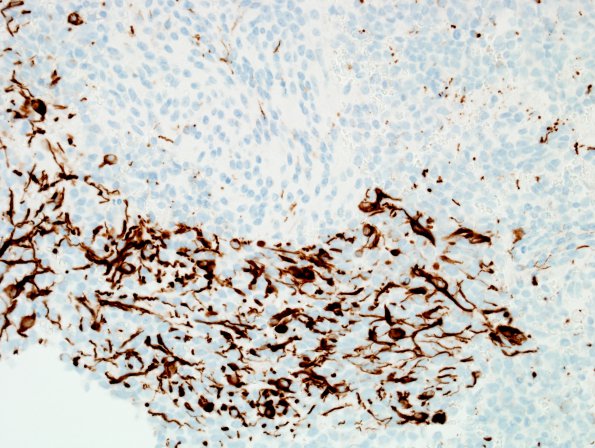 16C Medulloblastoma (Case 16) GFAP.jpg