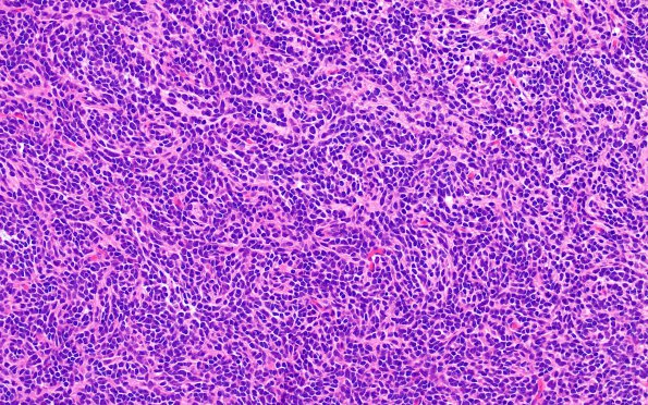 17A1 Medulloblastoma, SHH type (Case 17) H&E 3