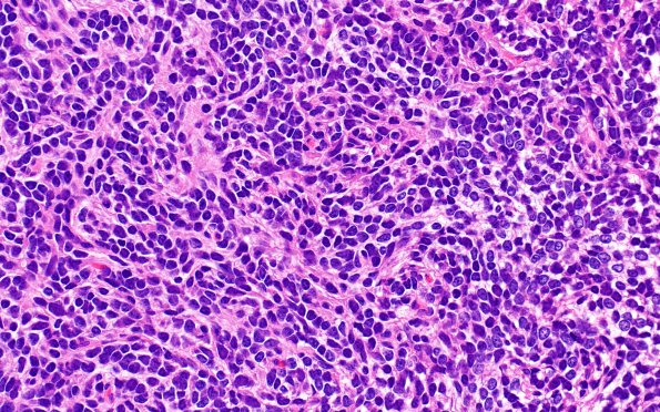 17A3 3Medulloblastoma, SHH type (Case 17) H&E 1