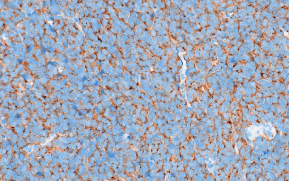 17B2 Medulloblastoma, SHH type (Case 17) SYN 1