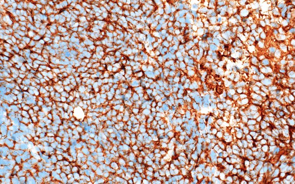 17C Medulloblastoma, SHH type (Case 17) Beta catenin 1