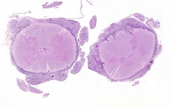 18A Medulloblastoma (AFIP TS M9665 set Slide # 19, RES image) H&E whole mount