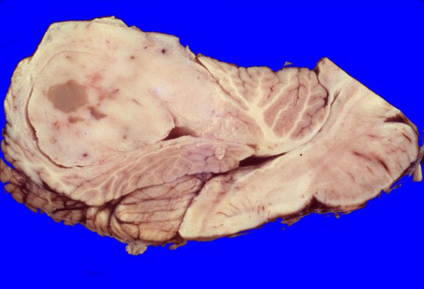 19A Medulloblastoma (Case 19) gross