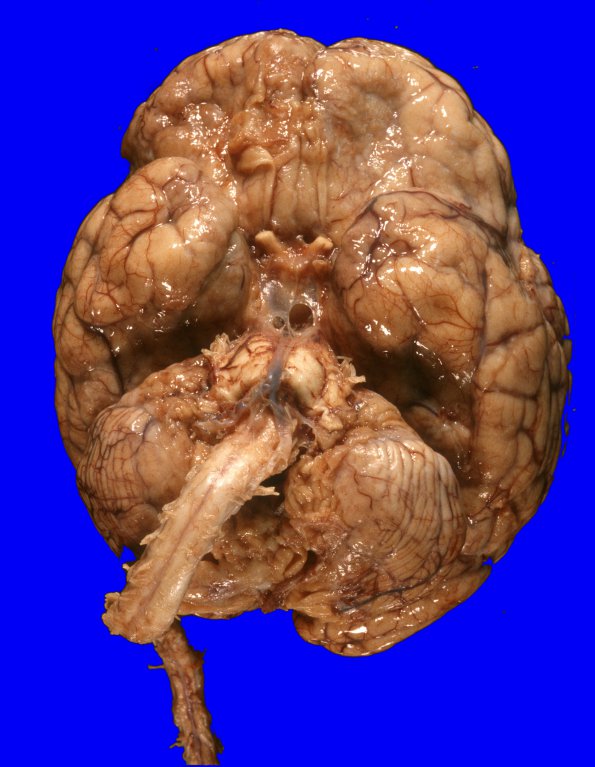 1A1 Medulloblastoma (Case 1) 13