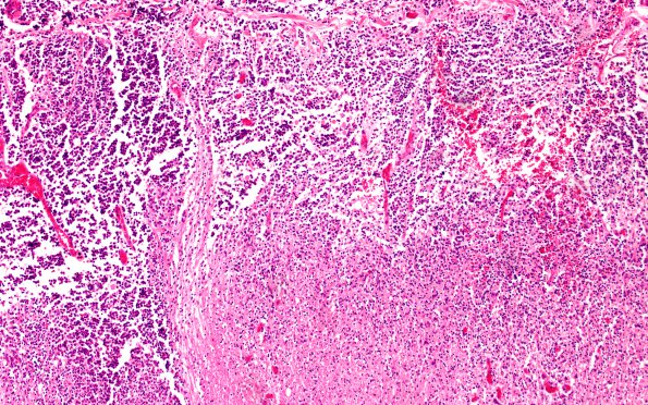 1A10 Medulloblastoma (Case 1) H&E N10 10X