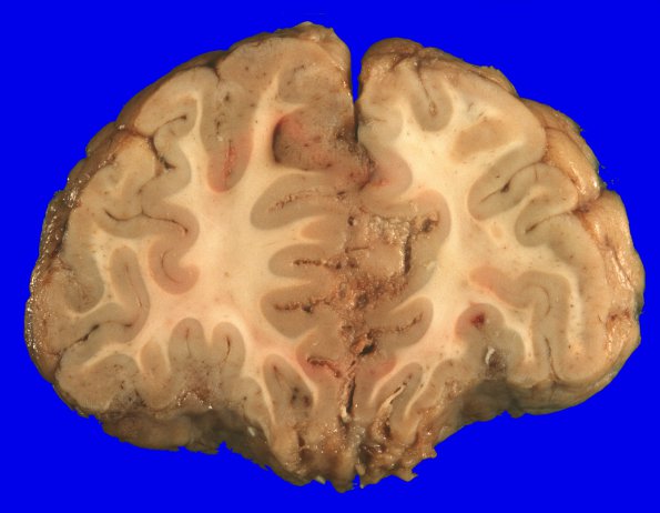 1A2 Medulloblastoma (Case 1) 11