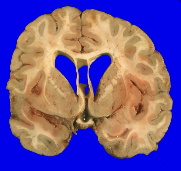 1A3 Medulloblastoma (Case 1) 12