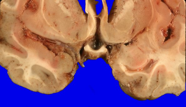 1A4 Medulloblastoma (Case 1) 10