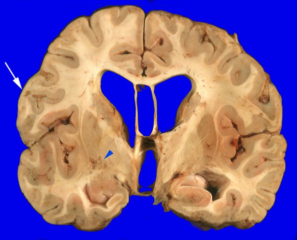 1A5 Medulloblastoma (Case 1) 1 copy copy