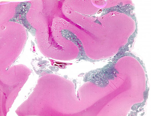 1A5A1 Medulloblastoma (Case 1) H&E WM 2