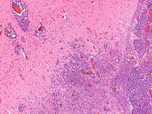 1A5A2 Medulloblastoma (Case 1) H&E WM 8