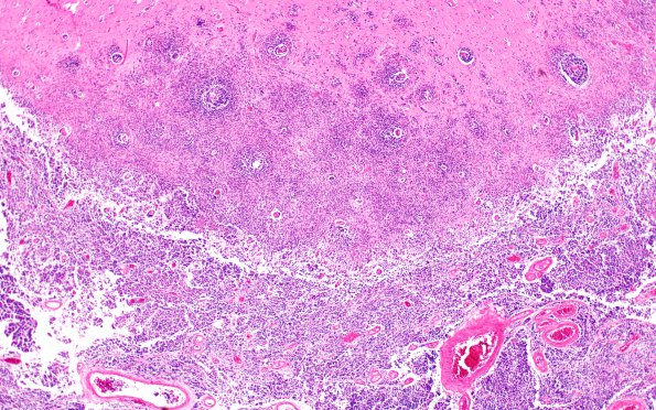 1A5A3 Medulloblastoma (Case 1) H&E N6 real 4X