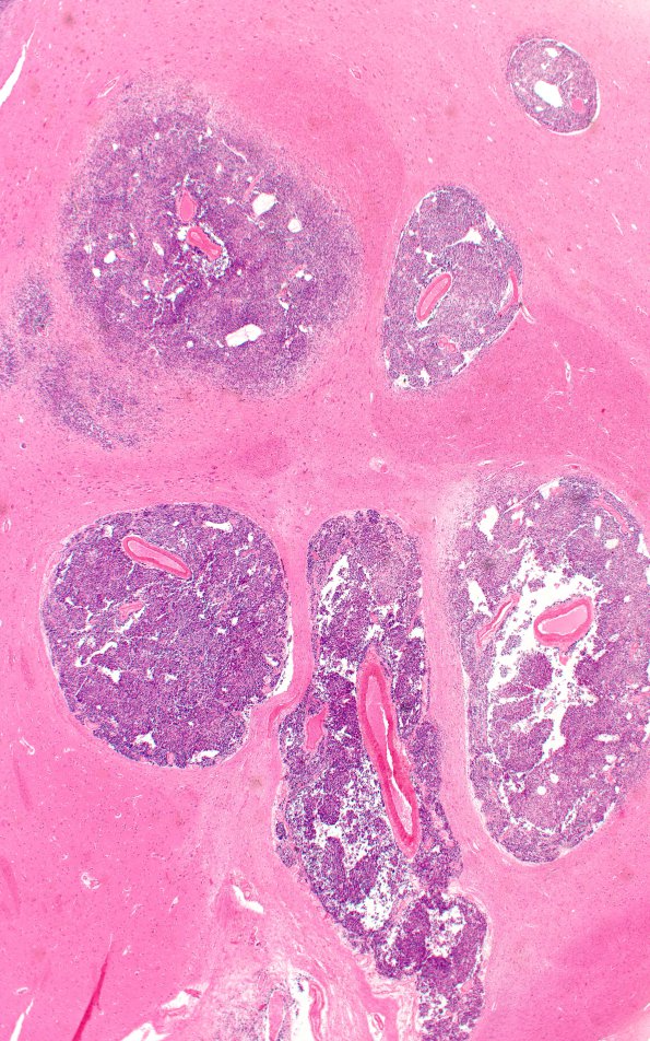 1A5A5 Medulloblastoma (Case 1) H&E N2 WM 4X