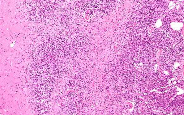 1A5A6 Medulloblastoma (Case 1) H&E N2 WM 10X