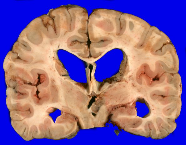 1A6 Medulloblastoma (Case 1) 9