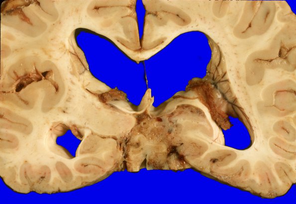 1A7 Medulloblastoma (Case 1) 5