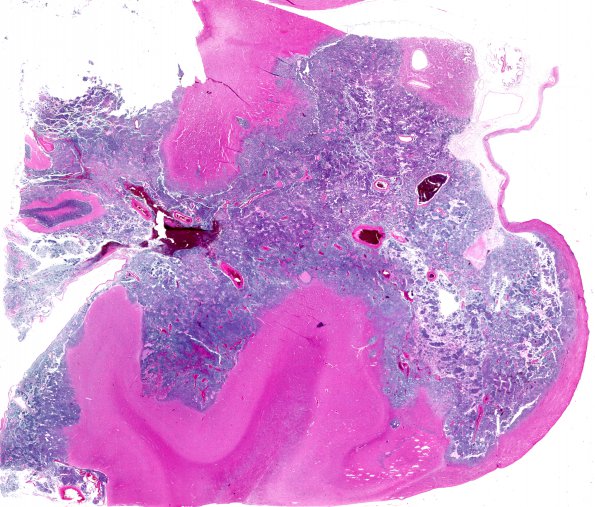 1A7A1 Medulloblastoma (Case 1) H&E WM 7