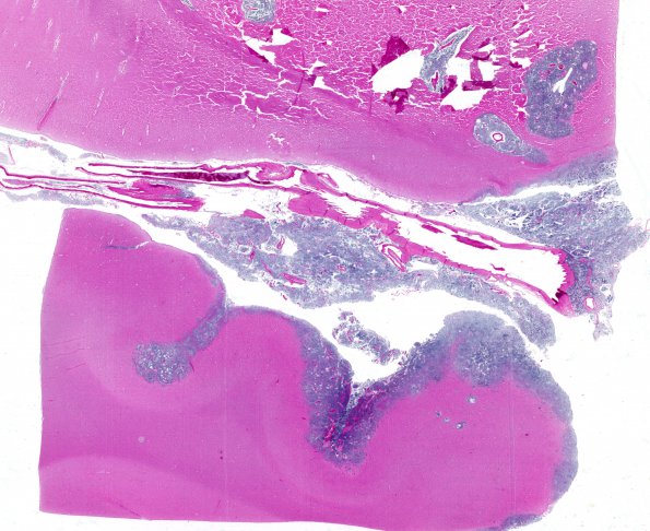 1A7A2 Medulloblastoma (Case 1) H&E WM 3