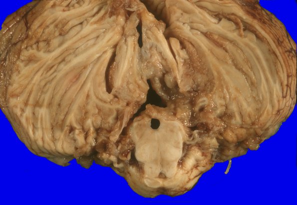 1A8 Medulloblastoma (Case 1) 3