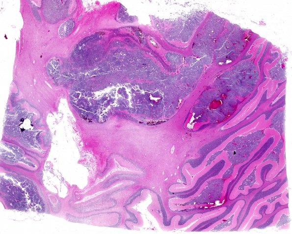 1A8A1 Medulloblastoma (Case 1) H&E WM 5