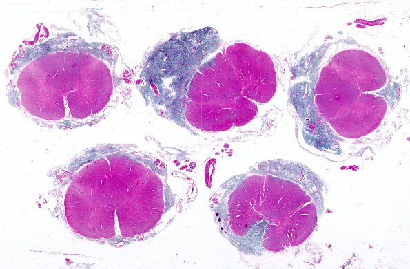 1A9 Medulloblastoma (Case 1) H&E WM 6