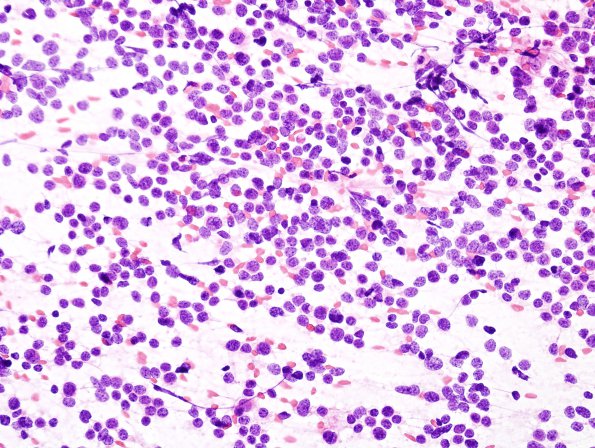 20A Medulloblastoma (Case 20) smear.jpg