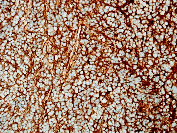 20B Medulloblastoma (Case 20) SYN.jpg