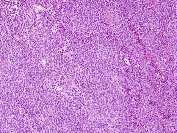 21A1 Medulloblastoma (Case 21) H&E 1