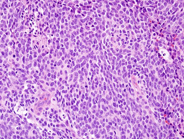 21A2 Medulloblastoma (Case 21) H&E 3