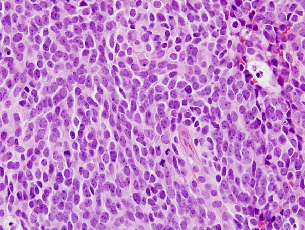 21A3 Medulloblastoma (Case 21) H&E 2