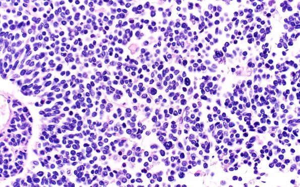 2B1 Medulloblastoma (Case 2) N5 H&E 40X 2