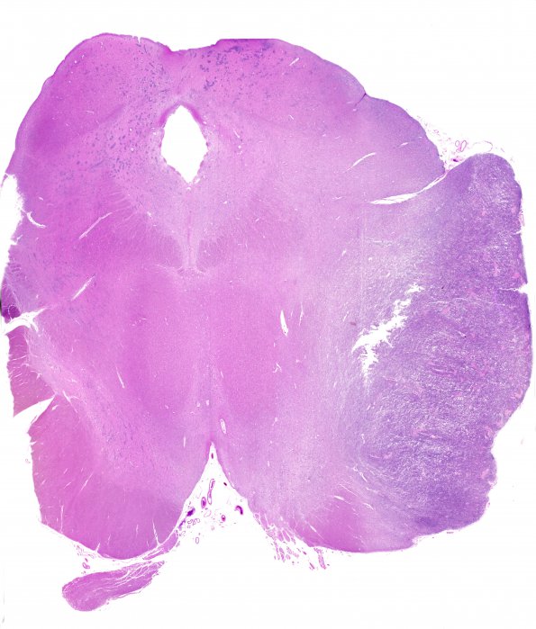 2B2 Medulloblastoma (Case 2)  N6 H&E WM