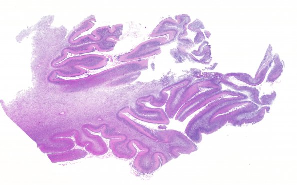 2B3 Medulloblastoma (Case 2) N15 H&E WM