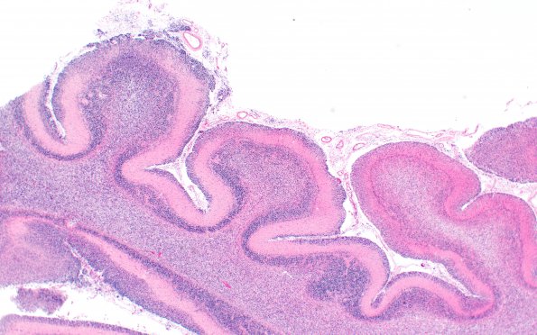 2B4 Medulloblastoma (Case 2) N15 H&E 2X